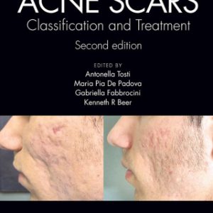 Acne Scars: Classification and Treatment 2nd Edition - Original PDF